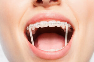 braces orthodontist in Boise ID